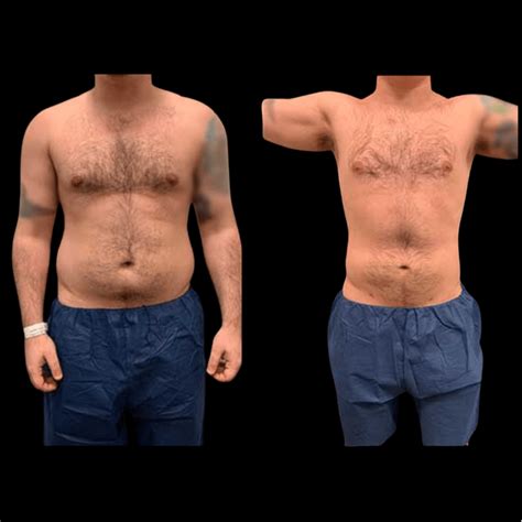 male liposuction miami|Male Plastic Surgery Miami